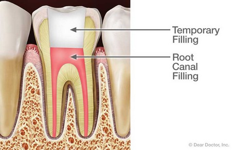 dt10312017121356afterrootcanal